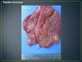 Papiller karsinom 17926/08 