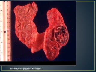 Tiroid tümörü (Papiller Karsinom?) 