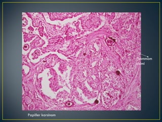 Papiller karsinom Psammom cisimi 