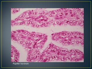 Papiller karsinom 