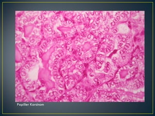 Papiller Karsinom 