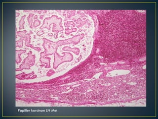 Papiller karsinom LN Met 