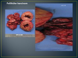 Folliküler karsinom 18321/08 