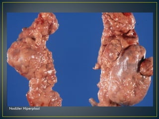 Nodüler Hiperplazi 
