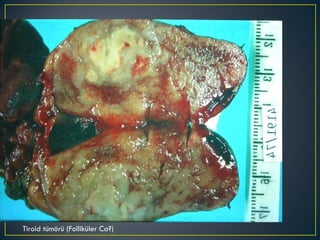 Tiroid tümörü (Folliküler Ca?) 