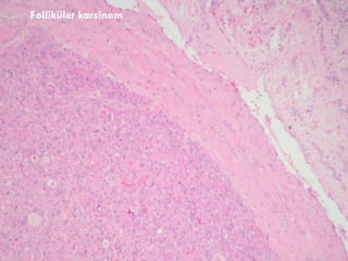 Folliküler karsinom 