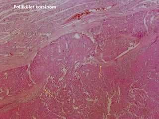 Folliküler karsinom 
