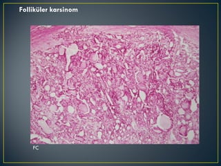 FC Folliküler karsinom 
