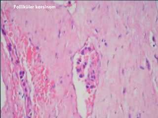 Folliküler karsinom 