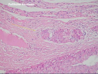 Folliküler karsinom 