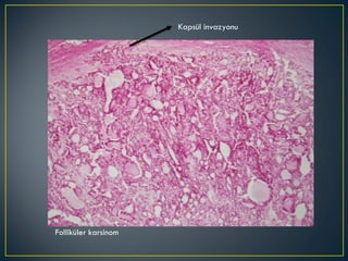 Folliküler karsinom Kapsül invazyonu 