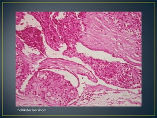 Folliküler karsinom 