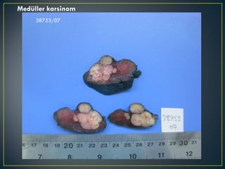 38753/07 Medüller karsinom 