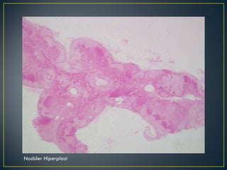 Nodüler Hiperplazi 