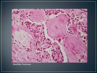 Medüller Karsinom 