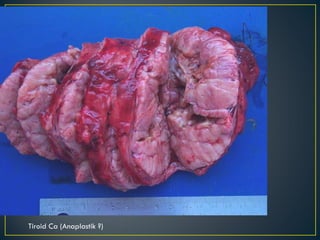 Tiroid Ca (Anaplastik ?) 