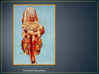Paratiroid Hiperplazisi 