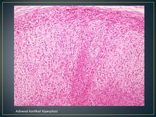 Adrenal kortikal hiperplazi 