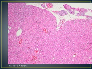 Paratiroid Adenom 