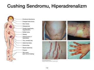 Cushing Sendromu, Hiperadrenalizm
132
 