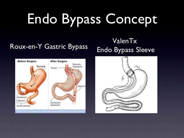 Endoluminal bariatric surgery