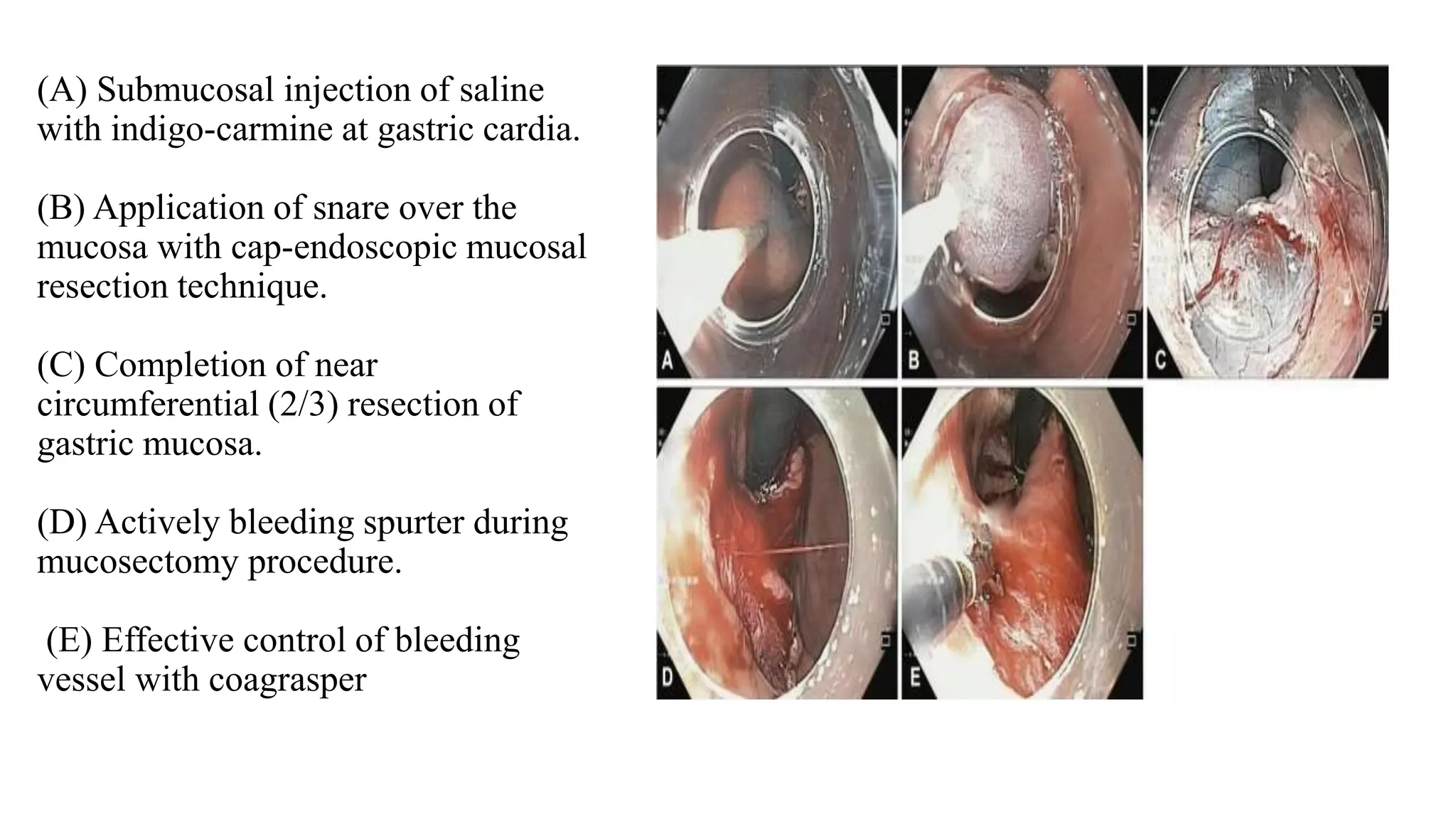 (A) Submucosal injection of saline
with indigo-carmine at gastric cardia.
(B) Application of snare over the
mucosa with cap-endoscopic mucosal
resection technique.
(C) Completion of near
circumferential (2/3) resection of
gastric mucosa.
(D) Actively bleeding spurter during
mucosectomy procedure.
(E) Effective control of bleeding
vessel with coagrasper
 