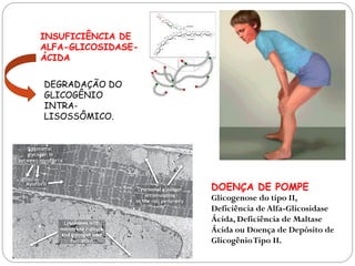 DOENÇA DE POMPE 
Glicogenose do tipo II, Deficiência de Alfa-Glicosidase Ácida, Deficiência de Maltase Ácida ou Doença de Depósito de Glicogênio Tipo II. 
INSUFICIÊNCIA DE ALFA-GLICOSIDASE- ÁCIDA 
DEGRADAÇÃO DO GLICOGÊNIO INTRA- LISOSSÔMICO.  