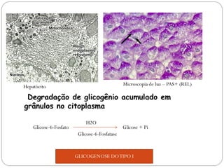 Hepatócito Microscopia de luz – PAS+ (REL) 
Degradação de glicogênio acumulado em 
grânulos no citoplasma 
Glicose-6-Fosfato Glicose + Pi 
Glicose-6-Fosfatase 
H2O 
GLICOGENOSE DO TIPO I 
 