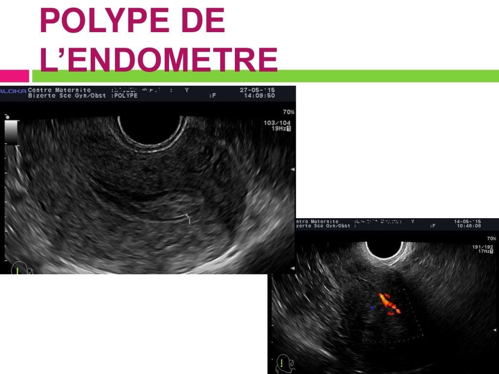Endometre1