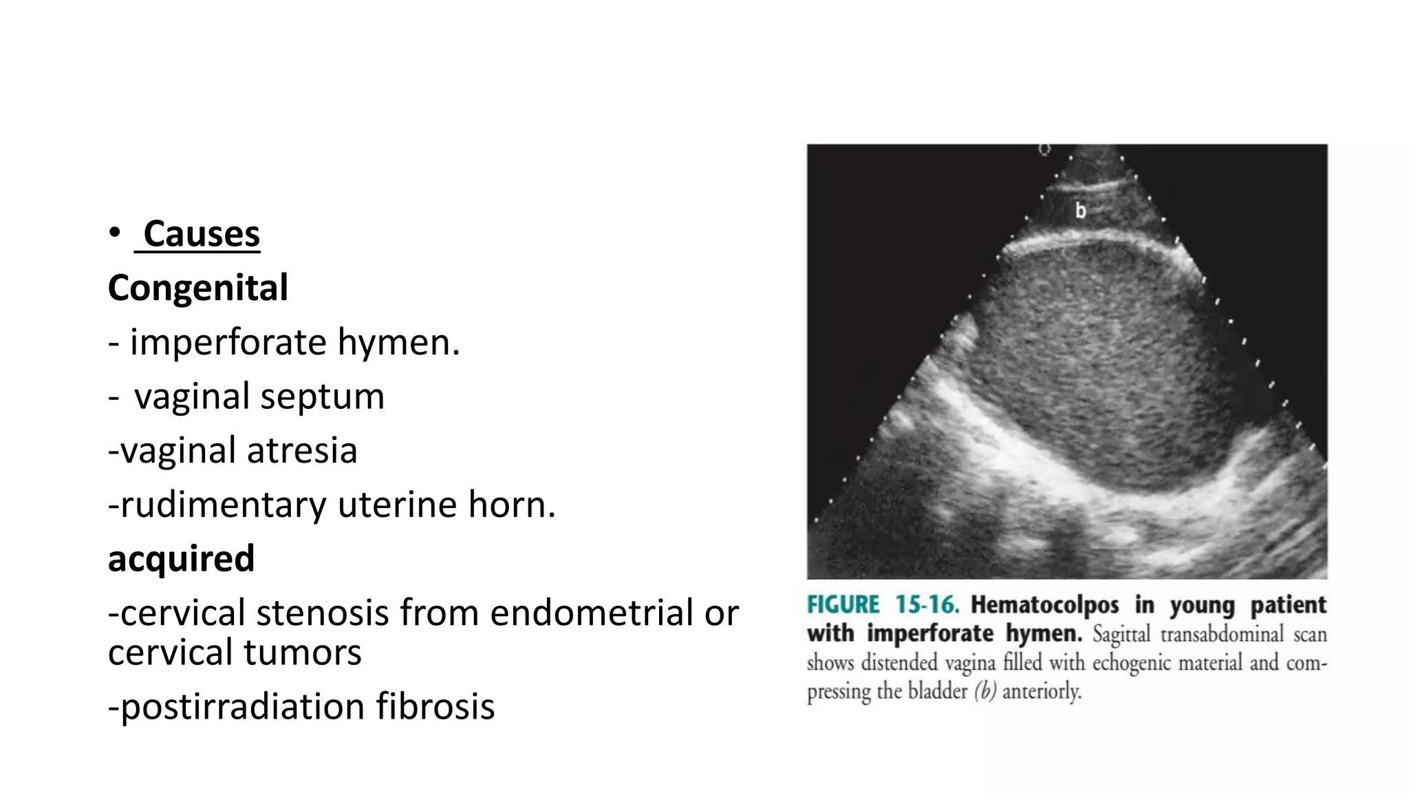 • Causes
Congenital
- imperforate hymen.
- vaginal septum
-vaginal atresia
-rudimentary uterine horn.
acquired
-cervical stenosis from endometrial or
cervical tumors
-postirradiation fibrosis
 