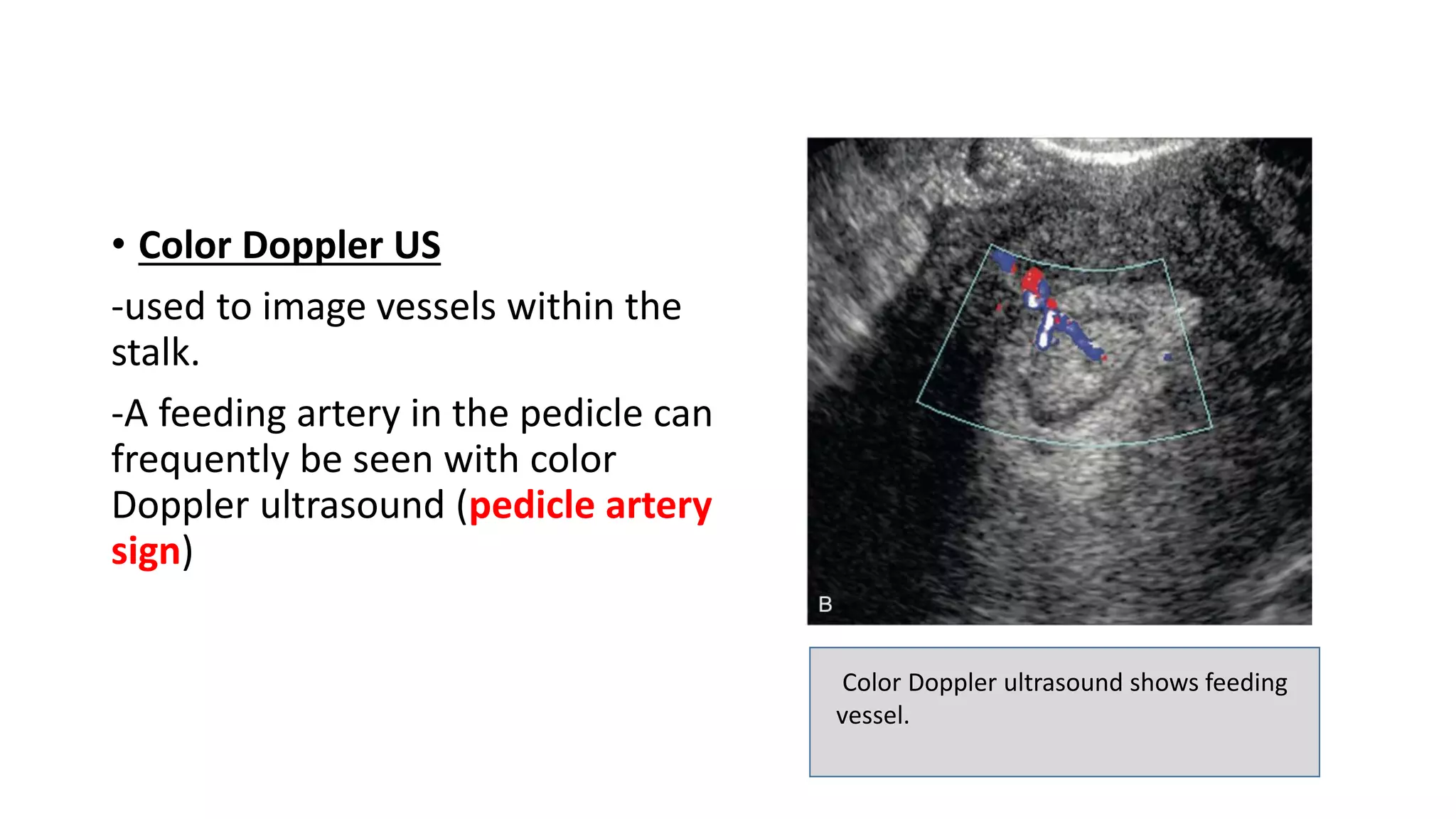 • Color Doppler US
-used to image vessels within the
stalk.
-A feeding artery in the pedicle can
frequently be seen with color
Doppler ultrasound (pedicle artery
sign)
Color Doppler ultrasound shows feeding
vessel.
 
