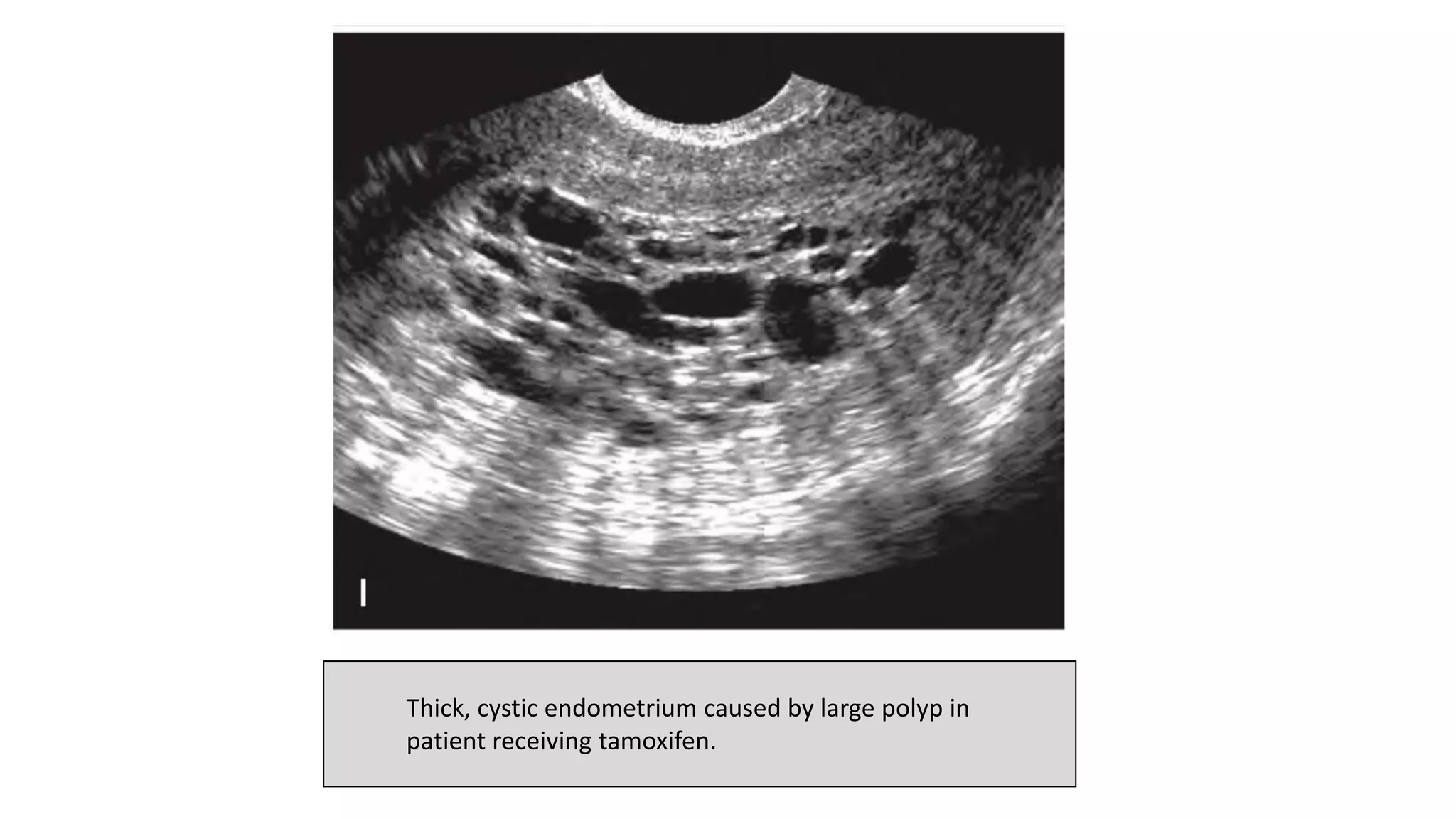 Thick, cystic endometrium caused by large polyp in
patient receiving tamoxifen.
 