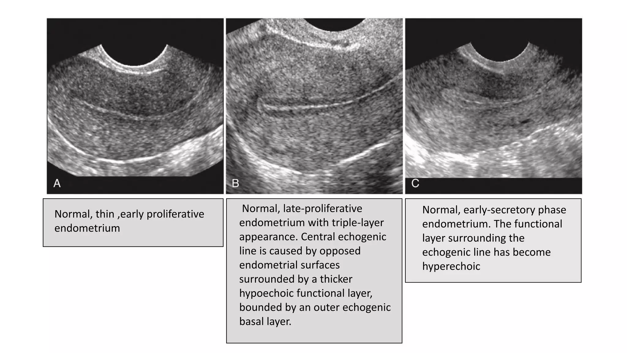 Normal, thin ,early proliferative
endometrium
Normal, late-proliferative
endometrium with triple-layer
appearance. Central echogenic
line is caused by opposed
endometrial surfaces
surrounded by a thicker
hypoechoic functional layer,
bounded by an outer echogenic
basal layer.
Normal, early-secretory phase
endometrium. The functional
layer surrounding the
echogenic line has become
hyperechoic
 
