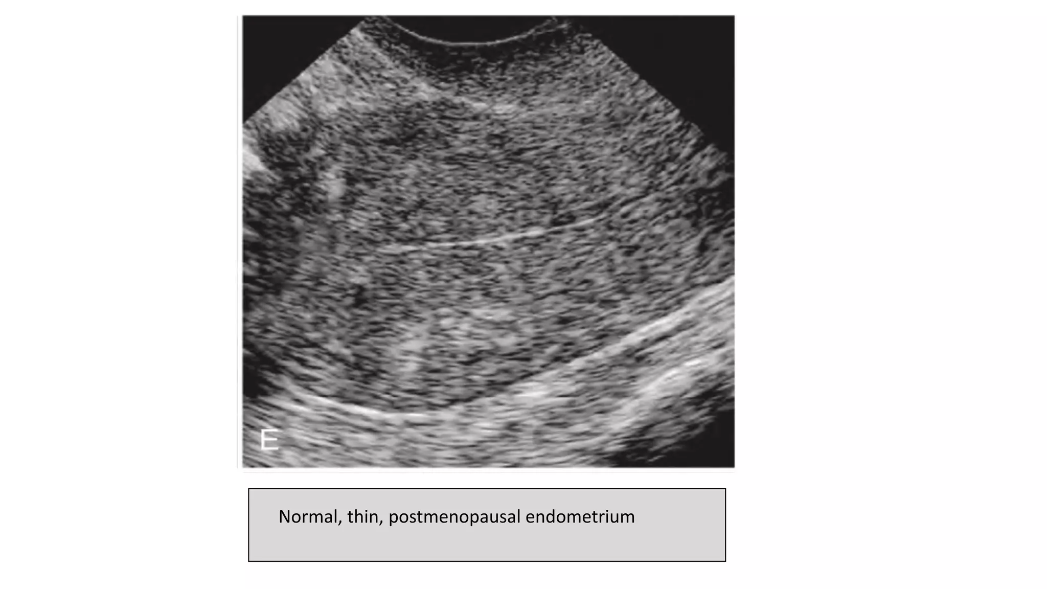 Normal, thin, postmenopausal endometrium
 