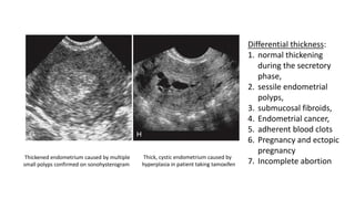Thickened endometrium caused by multiple
small polyps confirmed on sonohysterogram
Thick, cystic endometrium caused by
hyperplasia in patient taking tamoxifen
Differential thickness:
1. normal thickening
during the secretory
phase,
2. sessile endometrial
polyps,
3. submucosal fibroids,
4. Endometrial cancer,
5. adherent blood clots
6. Pregnancy and ectopic
pregnancy
7. Incomplete abortion
 