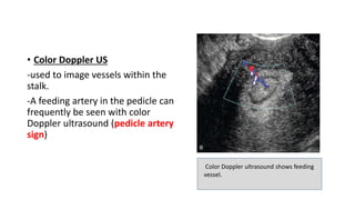 • Color Doppler US
-used to image vessels within the
stalk.
-A feeding artery in the pedicle can
frequently be seen with color
Doppler ultrasound (pedicle artery
sign)
Color Doppler ultrasound shows feeding
vessel.
 