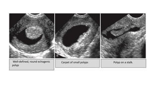 Well-defined, round echogenic
polyp
Carpet of small polyps Polyp on a stalk.
 