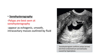 • Sonohysterography
-Polyps are best seen at
sonohysterography
-appear as echogenic, smooth,
intracavitary masses outlined by fluid
Sonohysterogram confirms polyp (arrow)
and thick endometrium (arrowheads)
caused by hyperplasia.
 