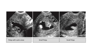 Polyp with cystic areas Small Polyp Small Polyp
 