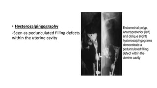 • Hysterosalpingography
-Seen as pedunculated filling defects
within the uterine cavity
 