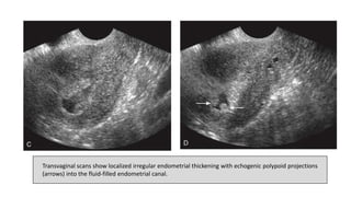 Transvaginal scans show localized irregular endometrial thickening with echogenic polypoid projections
(arrows) into the fluid-filled endometrial canal.
 