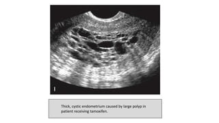 Thick, cystic endometrium caused by large polyp in
patient receiving tamoxifen.
 