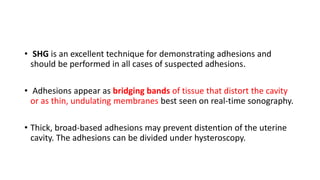 • SHG is an excellent technique for demonstrating adhesions and
should be performed in all cases of suspected adhesions.
• Adhesions appear as bridging bands of tissue that distort the cavity
or as thin, undulating membranes best seen on real-time sonography.
• Thick, broad-based adhesions may prevent distention of the uterine
cavity. The adhesions can be divided under hysteroscopy.
 