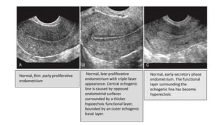 Normal, thin ,early proliferative
endometrium
Normal, late-proliferative
endometrium with triple-layer
appearance. Central echogenic
line is caused by opposed
endometrial surfaces
surrounded by a thicker
hypoechoic functional layer,
bounded by an outer echogenic
basal layer.
Normal, early-secretory phase
endometrium. The functional
layer surrounding the
echogenic line has become
hyperechoic
 