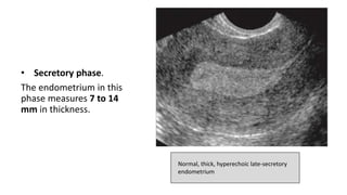 Normal, thick, hyperechoic late-secretory
endometrium
• Secretory phase.
The endometrium in this
phase measures 7 to 14
mm in thickness.
 
