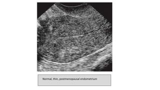 Normal, thin, postmenopausal endometrium
 