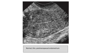Endometrial abnormalities