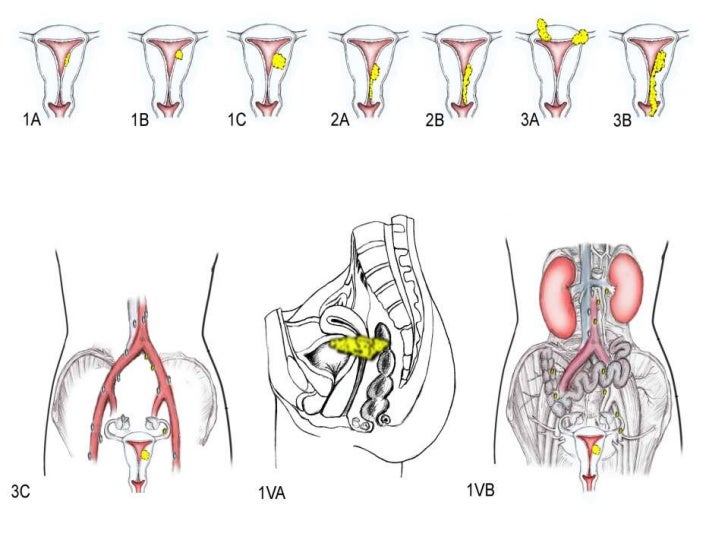endometrial-cancer