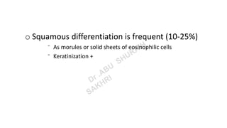 o Squamous differentiation is frequent (10-25%)
⁻ As morules or solid sheets of eosinophilic cells
⁻ Keratinization +
 
