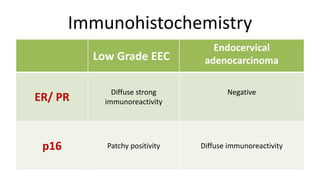 Immunohistochemistry
Low Grade EEC
Endocervical
adenocarcinoma
ER/ PR
Diffuse strong
immunoreactivity
Negative
p16 Patchy positivity Diffuse immunoreactivity
 